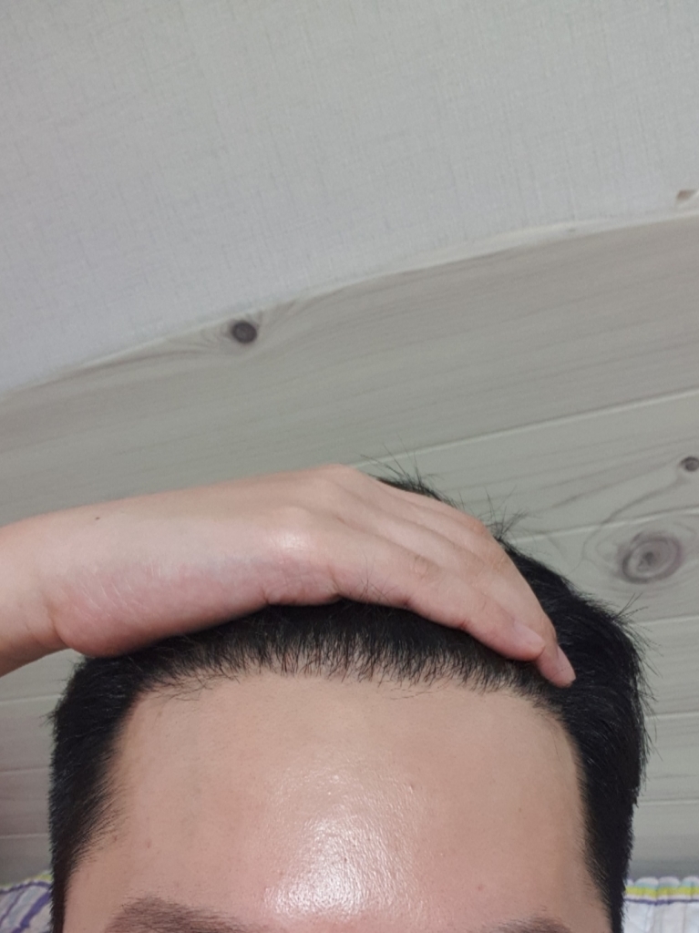 수술 158일(5개월) 경과 올립니다.