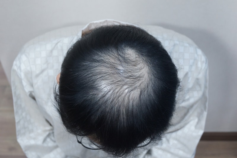 This is the 8th day after the procedure.scabism.