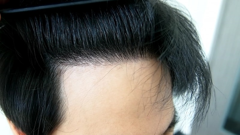 Cut 2800 hair transplant[3] 8 months old! (I have a selfie~)