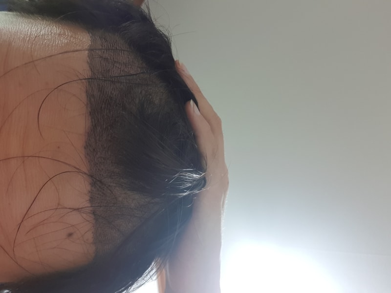 비절개 6일차 평가