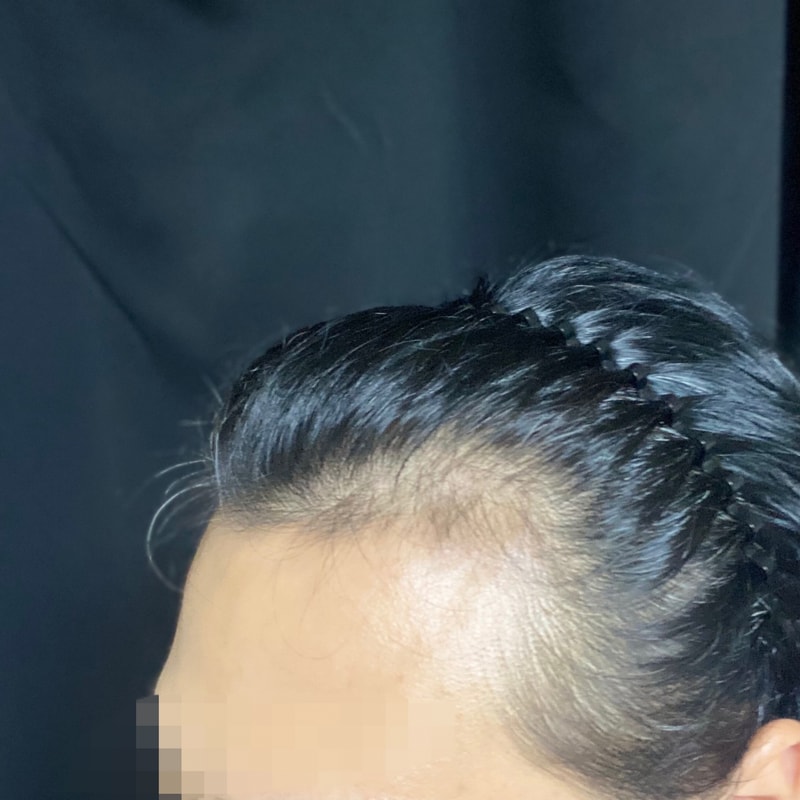 다나에서 저도 모발이삭했습니다