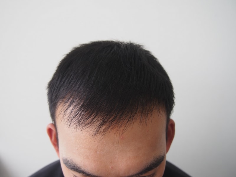 1400모낭 수술 8개월 지났습니다.