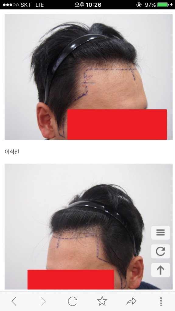 모재성 헤어라인 구렛나루  비절개 1414모낭 6개월
