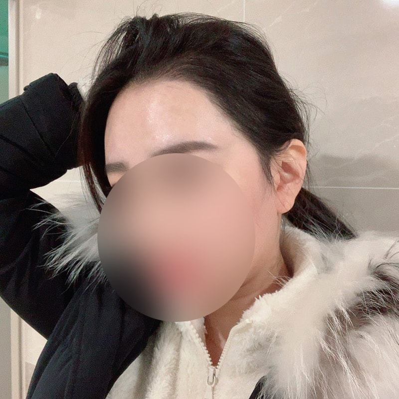 다나에서 수술하고 벌써 6개월이네요 ^^