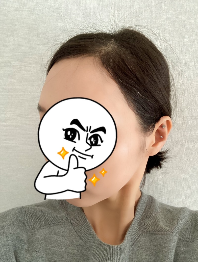 다나에서 수술했어요. 6개월~