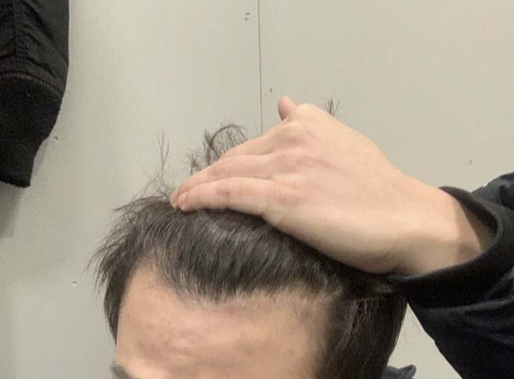 2500모 비절개 이식 1년 경과