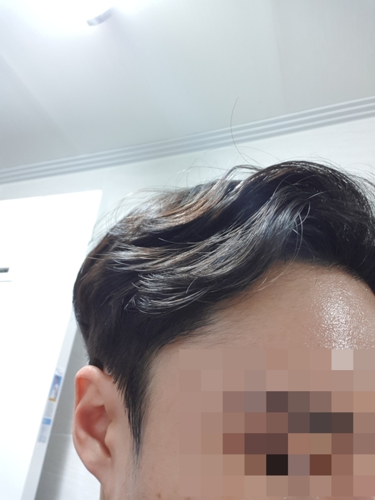 절개식 모발이식 6개월차 입니다