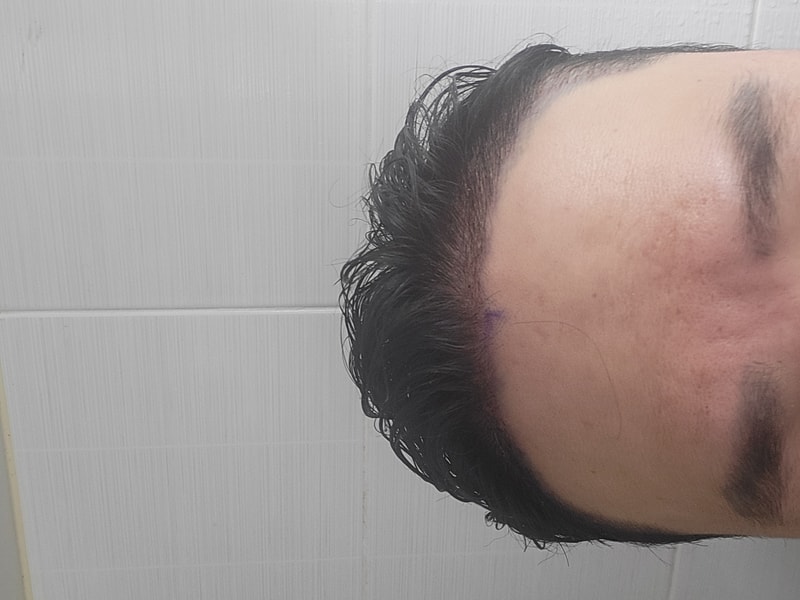 수술 후 앞.jpg