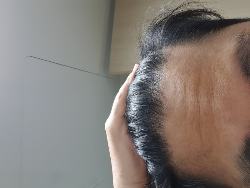 It's been 6 months since the hair transplant