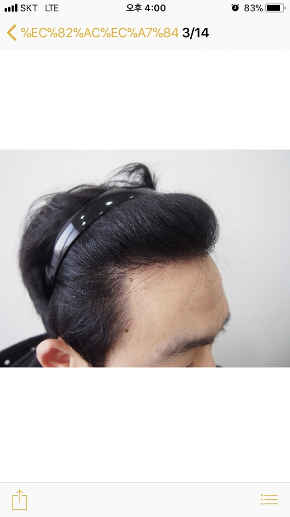 이식 9개월차 입니다.