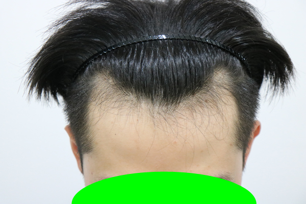 모발이식 6개월 째 맞이한 설날