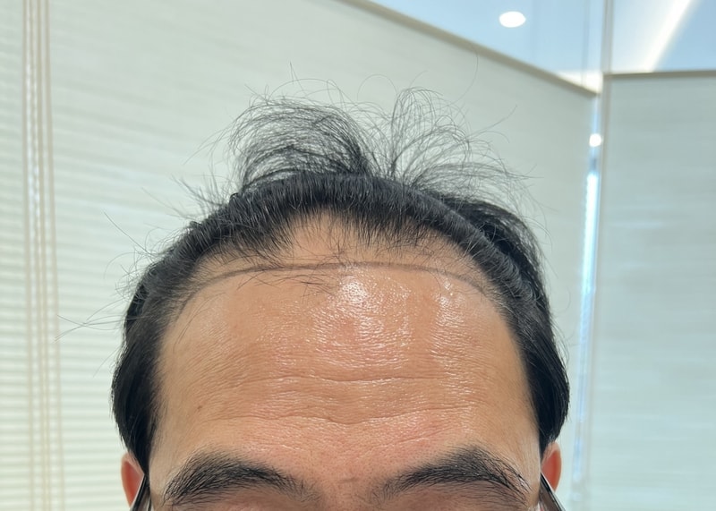 모발이식_전.JPG
