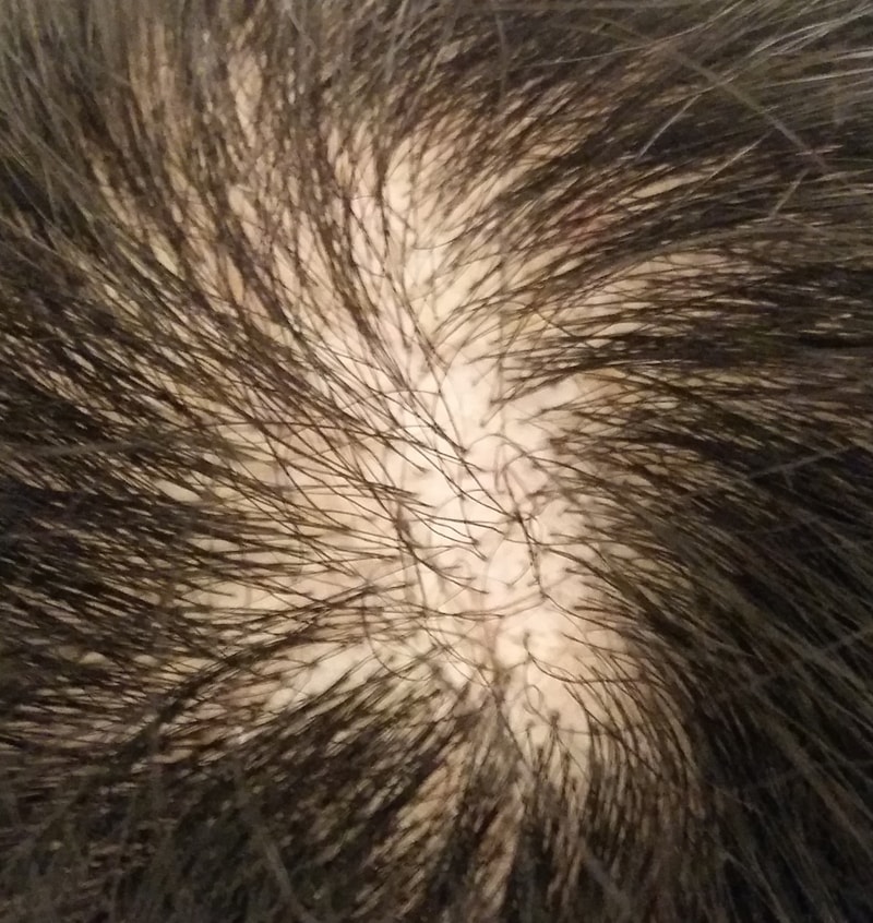 back scar.jpg