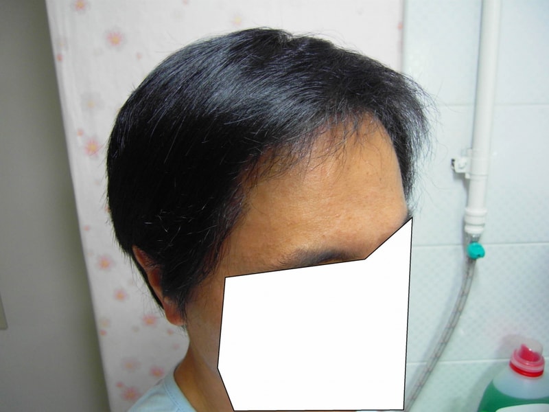 수술 후 7개월-3.jpg