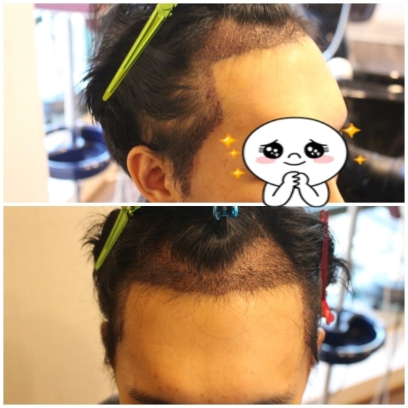 수술후 다음날 샴푸.jpg