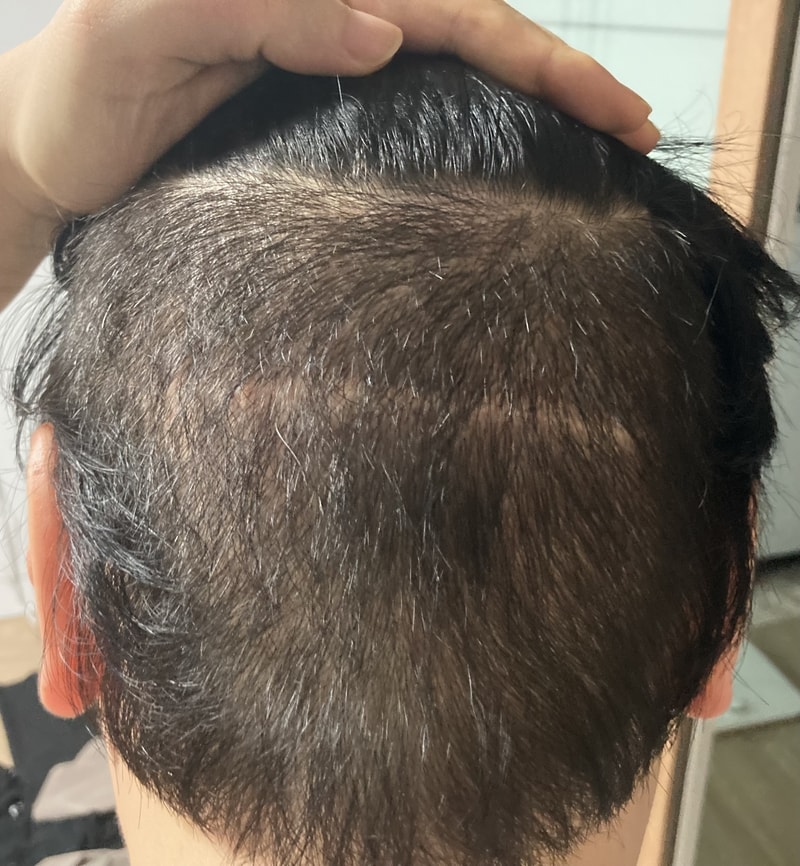 38일째 가발반납 및 두피관리