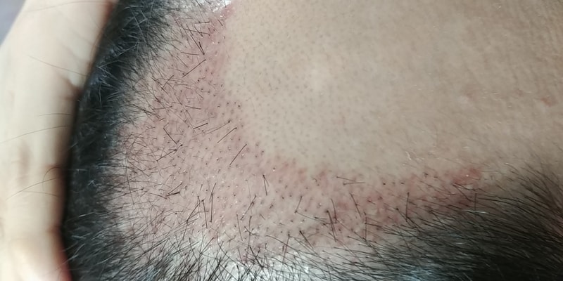수술 28일째 머리가 올라오기 시작하네요