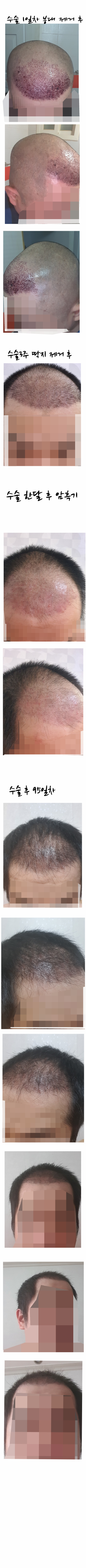대구 뉴헤어 2000모낭 삭발 비절개 모발이식(3개월 후기)