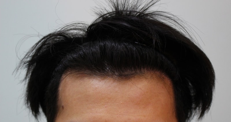 수술후 15개월 (5).JPG