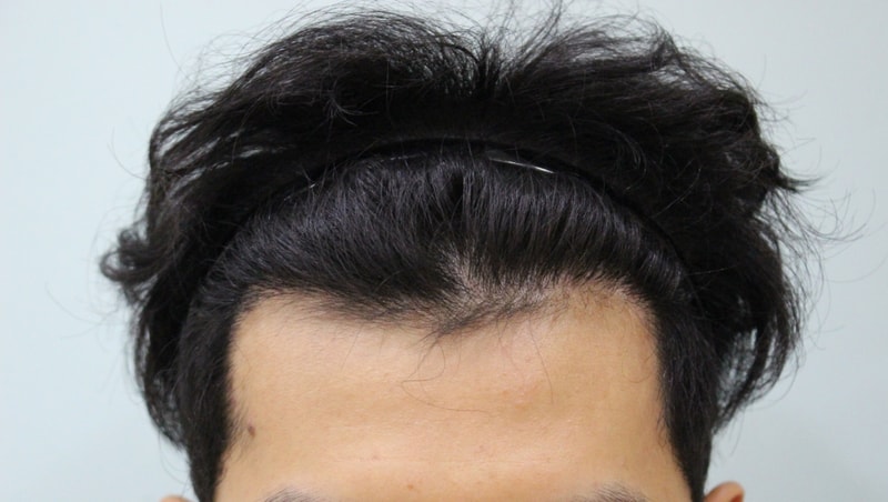 수술후8개월 (2).JPG