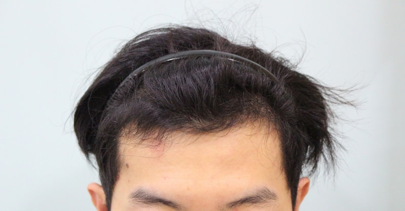수술후 4개월 (4).JPG