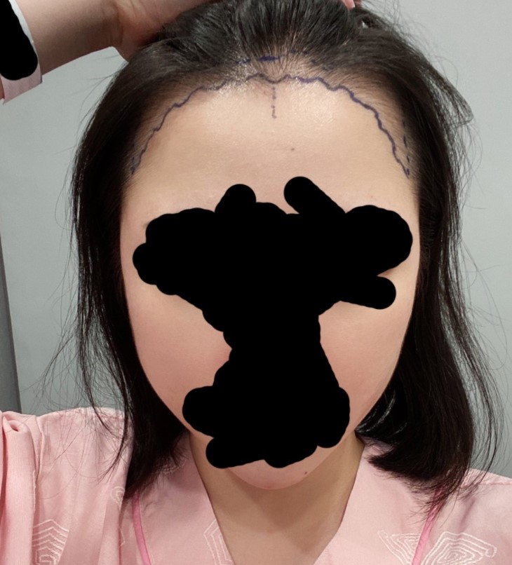 다나 절개 한달 넘었어요!