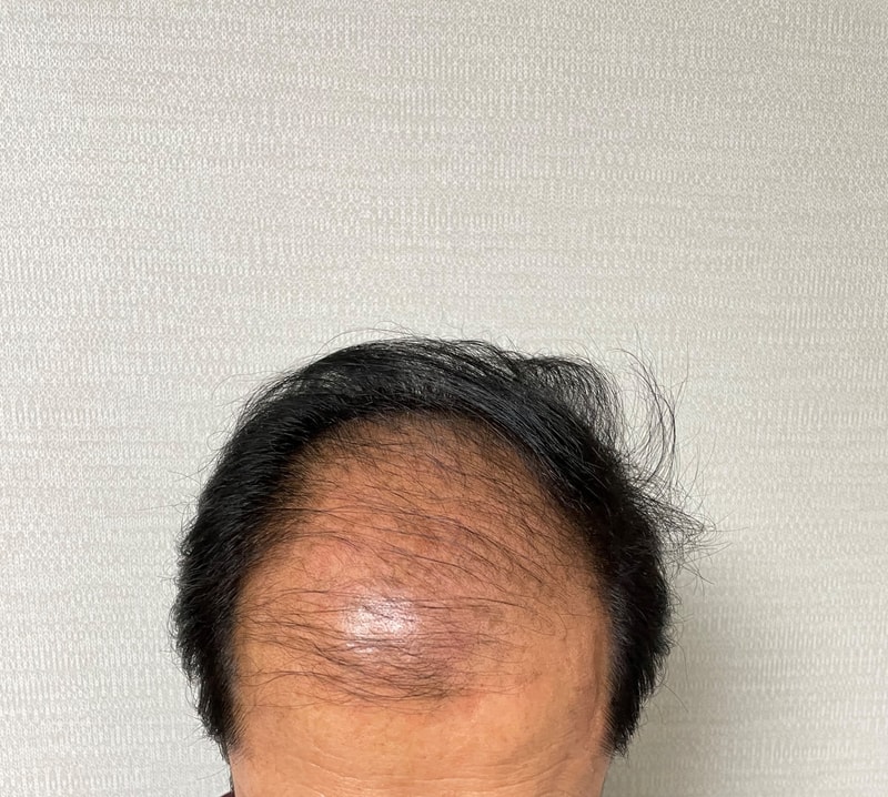다나성형외과 3800모낭 모발이식을 받았습니다.