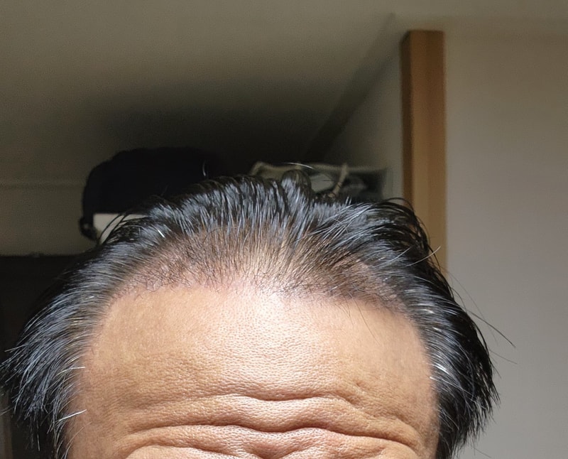 다나 무삭발 2700모낭 이식 19일 경과
