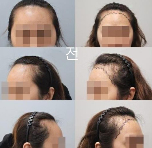 다나 절개 3800모 1년~~후기