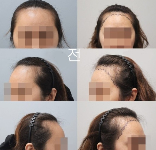 다나 절개3800모 7개월~ 후기
