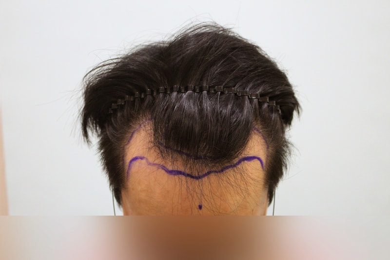 수술전 디자인 5.jpg