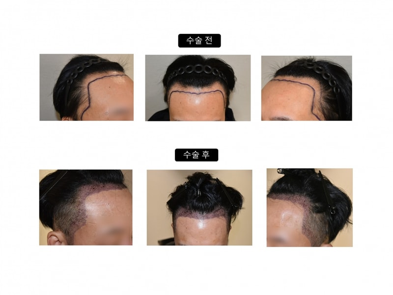 수술전후 이미지 대다모.jpg