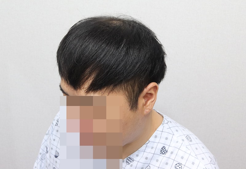 수술전 좌측.JPG