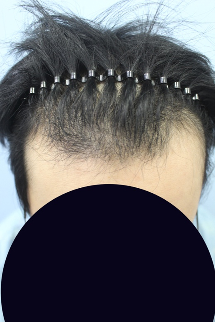 절개 3400모 7개월 후기 남겨봅니다
