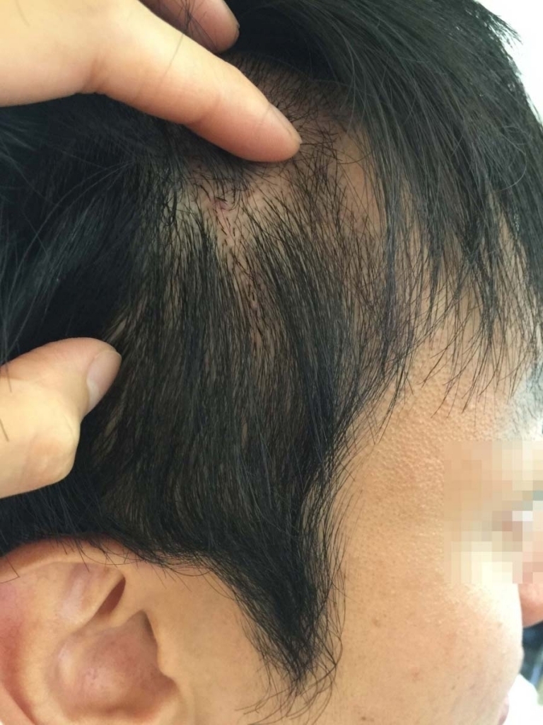 크기변환_수술후 17일 흉터 이식.JPG