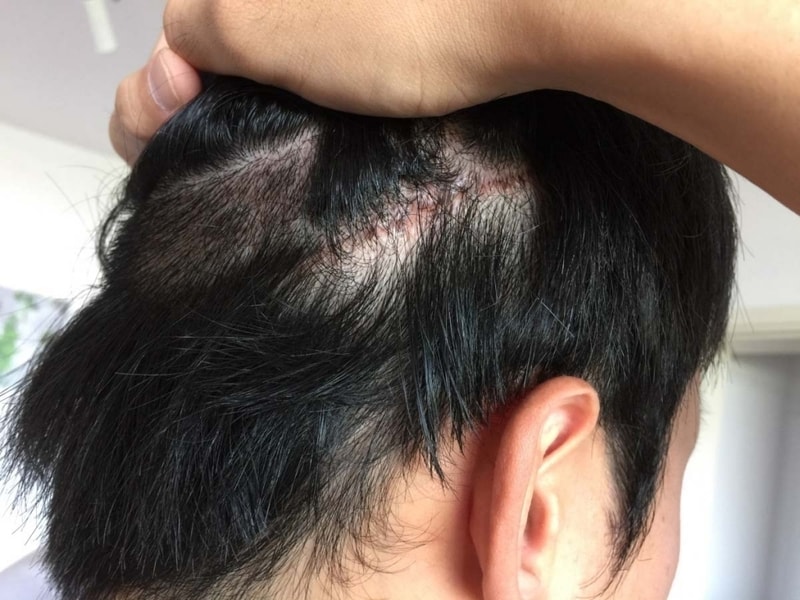 크기변환_수술후 15일 흉터.JPG