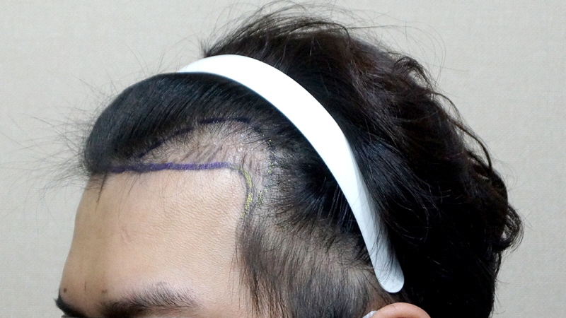 This is the second day of motion 1200 follicle surgery