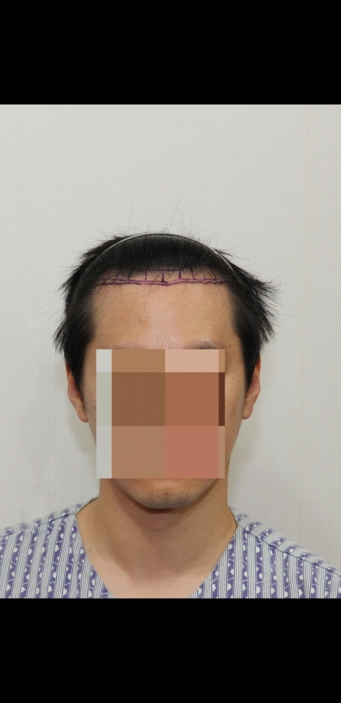 뉴헤어 절개 1437모낭 10일차 사진입니다