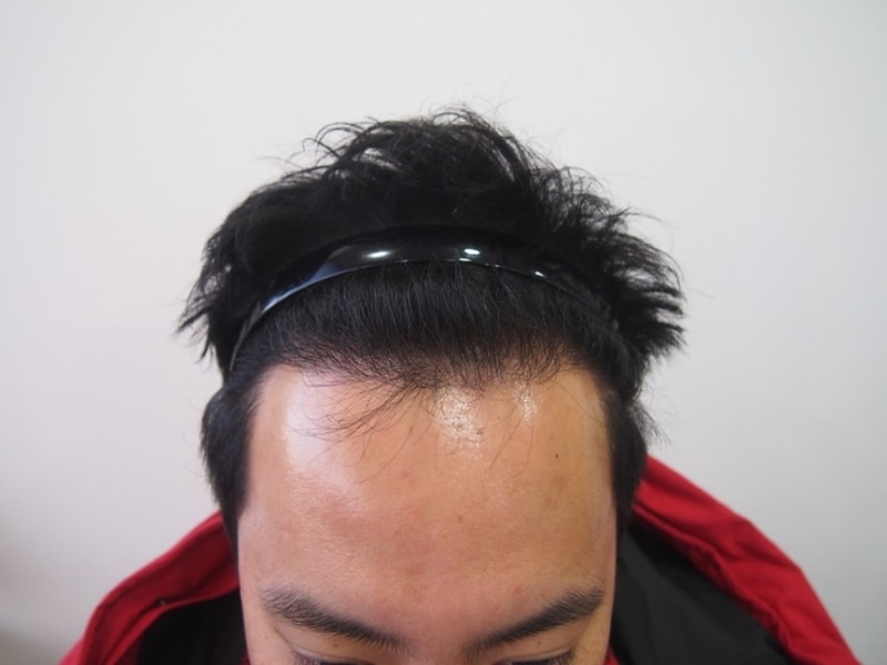 8개월경과 사진 올립니다.