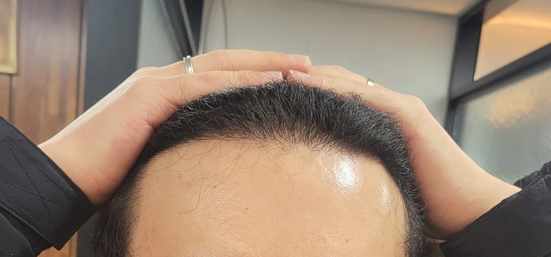 [모재성]모발이식 8개월차 후기입니다