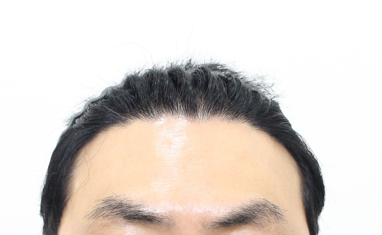 수술후 일년 경과 후기