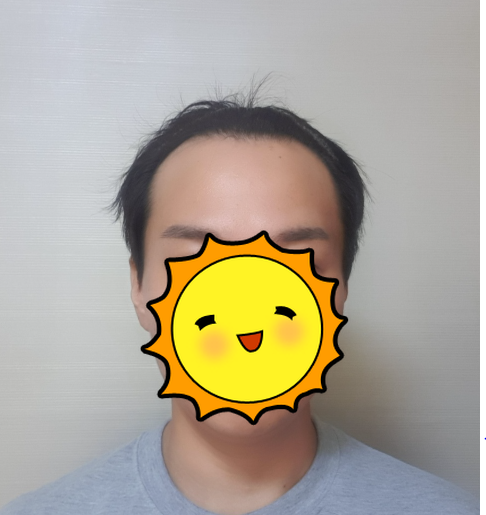 한성수 수술전.PNG