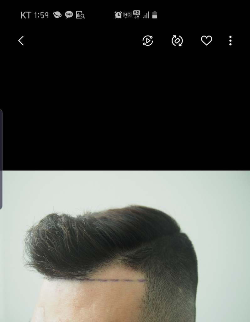 (모재성)750모낭 1년 후기