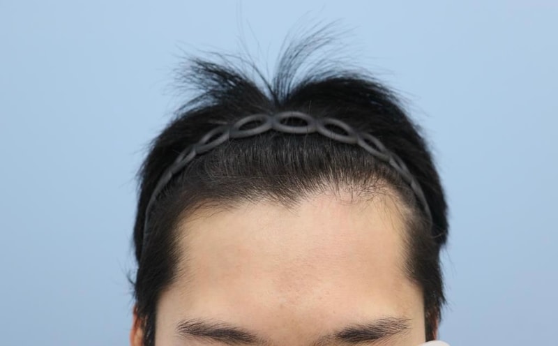 압구정모비앙 비절개 2000모 1년 후기