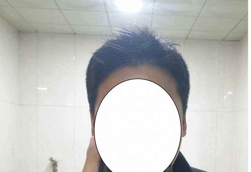 모발이식 1년 경과 후기 및 사진입니다.