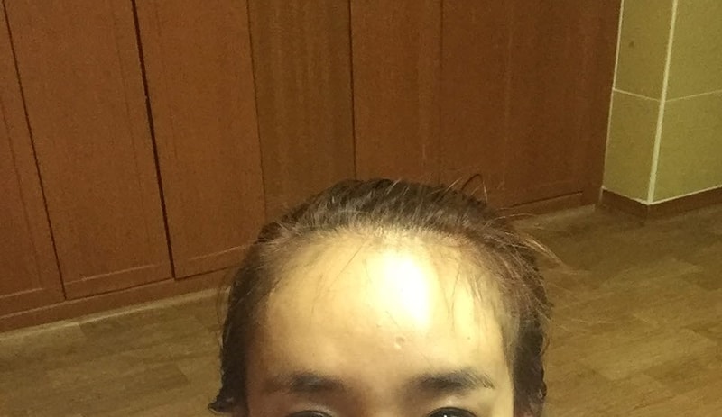 성형외과 다나 마지막 후기에요~