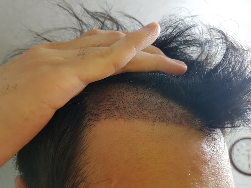 비절개 1200모낭 이식 11일차 딱지제거 후 평가 부탁드립니다
