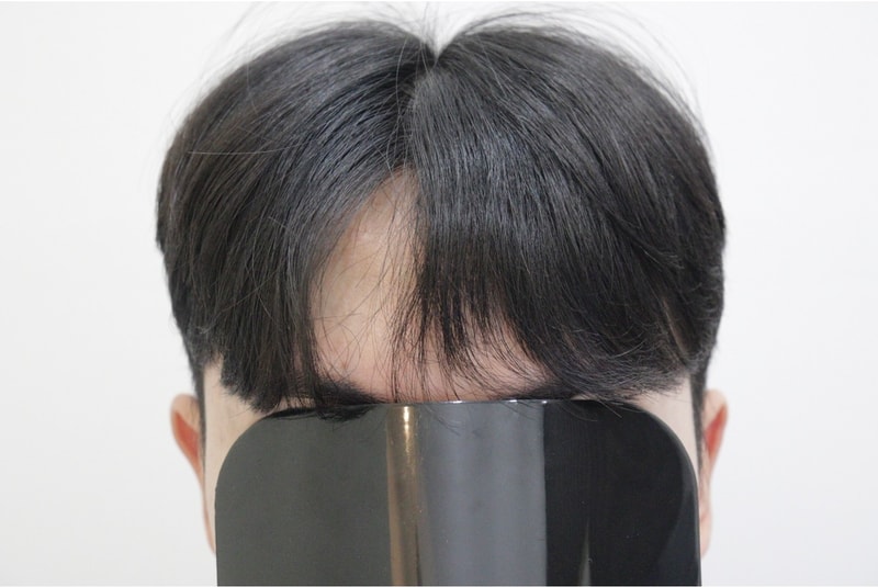 광주 압구정모비앙의원 모발이식 10개월 경과 후기