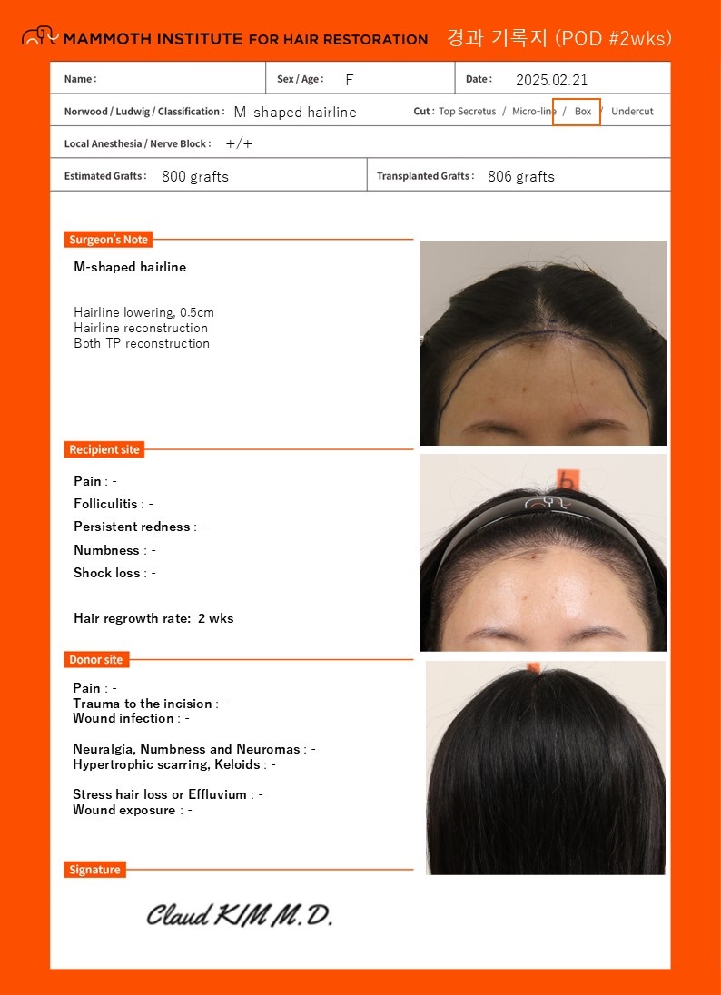 Busan Mammoth Hairline Correction after 2 weeks