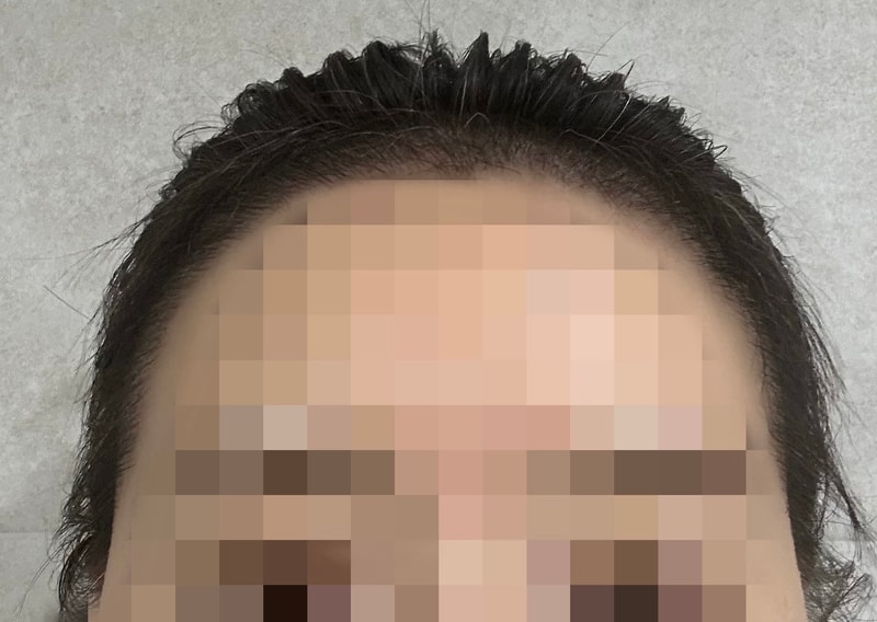 절개, 1800모낭, 수술 후 3개월 차 입니다.